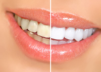 Teeth Whitening | Dentist in Magnolia, TX | Gary Squyres DDS